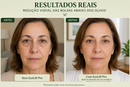 EyeLift Pro™ - Tecnologia regeneradora contra bolsas e olheiras